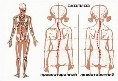 сколиоз сколиоз