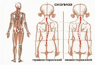 сколиоз