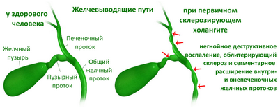 холангит