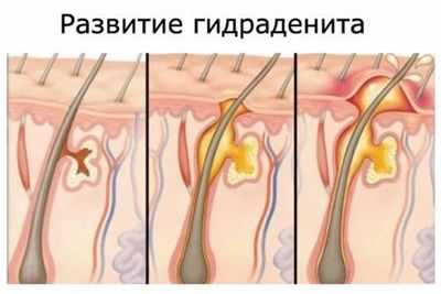 Дермцидин может играть роль в патогенезе кожного заболевания гнойный гидраденит