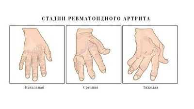 Ревматоидный артрит - это два разных заболевания?